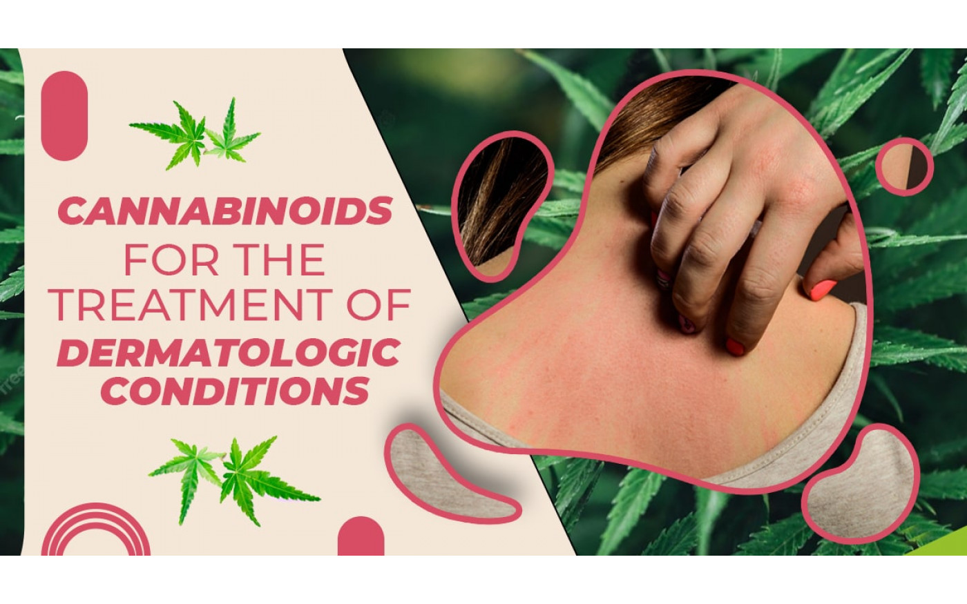 Cannabinoids For The Treatment Of Dermatologic Conditions